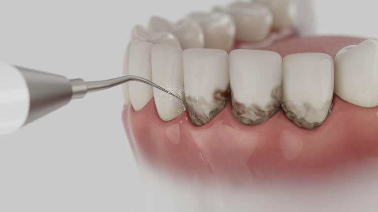 Trusted Wisdom Tooth Removal service in Riverbend, WA - Dentist Open Now